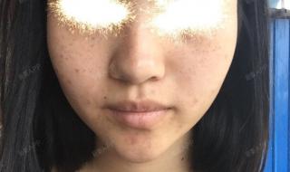 医院点斑多少钱